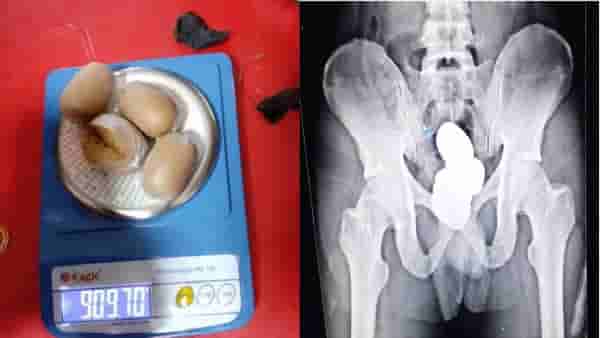 तस्कराने चक्क शरीराच्या या भागात लपवली सोन्याची पेस्ट, कल्पनेच्याही पलिकडे