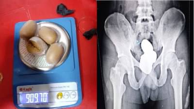 तस्कराने चक्क शरीराच्या या भागात लपवली सोन्याची पेस्ट, कल्पनेच्याही पलिकडे