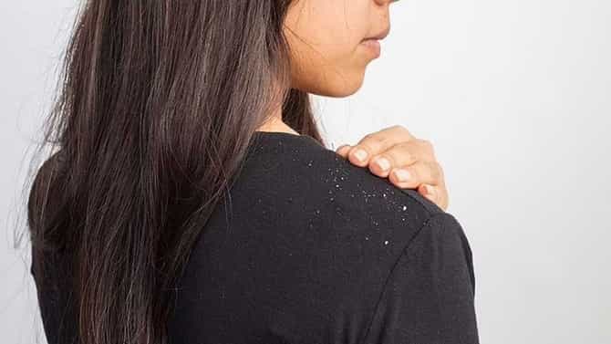Hair Care : डोक्यातील कोंडा आणि केस गळती कमी करण्यासाठी लसणाचा हा हेअर पॅक वापरा!