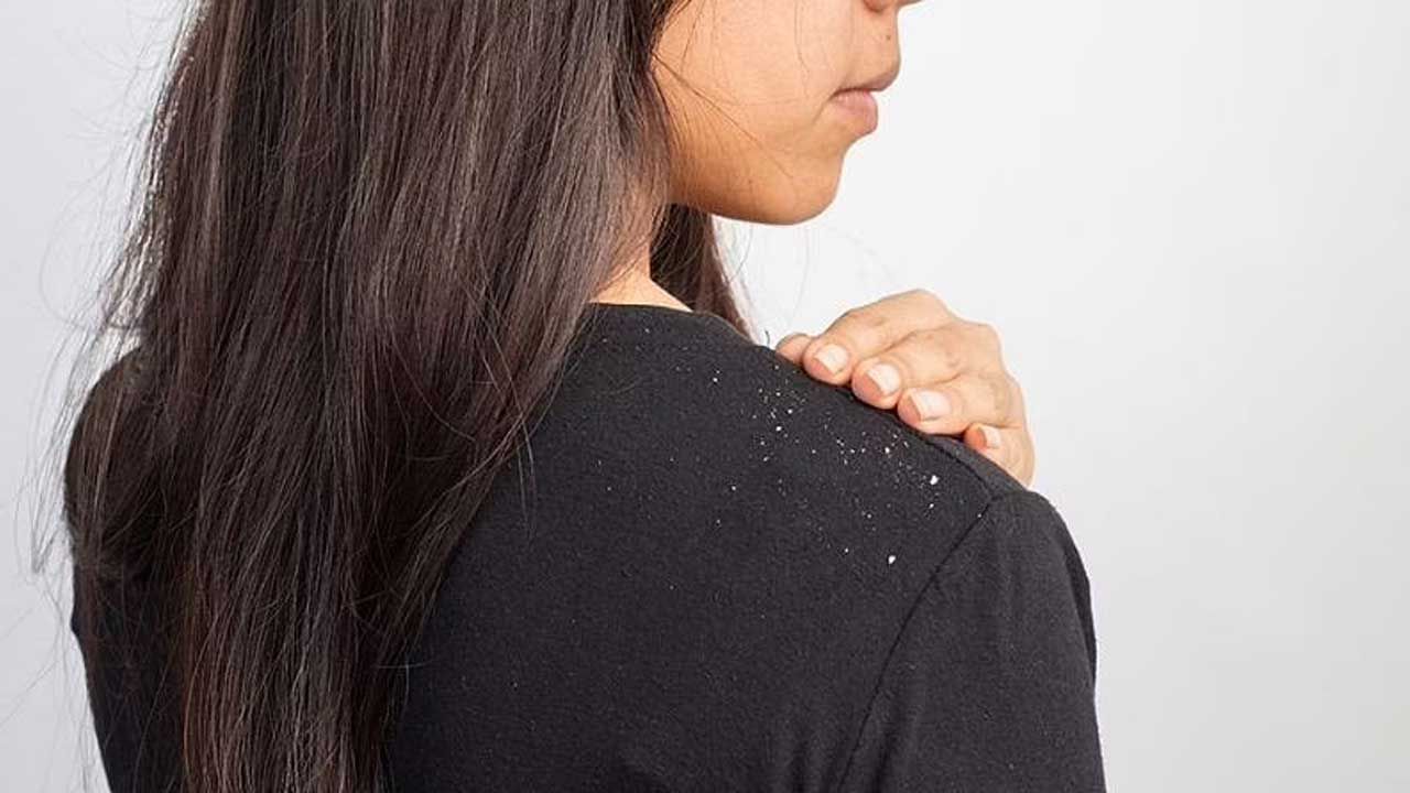 Dandruff | हिवाळ्यात कोंडा देतोय त्रास? मग करा घरच्या घरी हे उपाय Dandruff | हिवाळ्यात कोंडा देतोय त्रास? मग करा घरच्या घरी हे उपाय