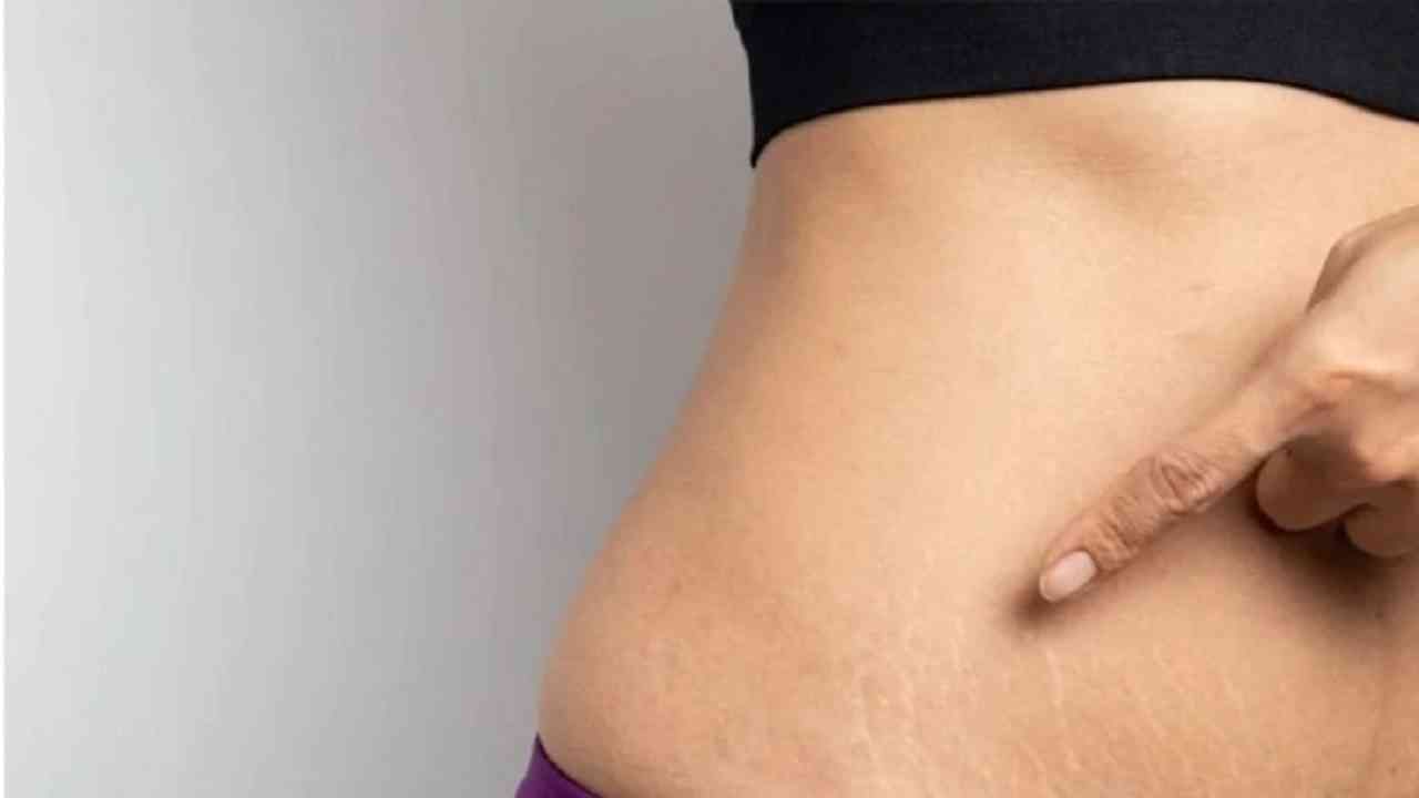 Stretch Marks स्ट्रेच मार्क्सचा त्रास होत असेल तर हे घरगुती उपाय नक्की करून पाहा Marathi 4706