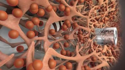 देशातील सर्वात पहिली काचबिंदू शस्त्रक्रिया यशस्वी, 3 रुग्णांना नवी दृष्टी