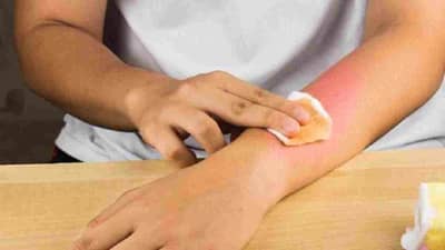 फटाके फोडताना, फराळ बनवताना भाजतं, चटका बसलाय का? हे घरगुती उपाय नक्की करुन पाहा