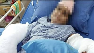 सासऱ्याचा तलवार हल्ला, सुनेचे दोन्ही हात कापले, डॉक्टरांनी 9 तासांच्या शस्त्रक्रियेनंतर पुन्हा जोडले