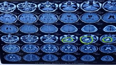 Mira Road | तरुणाच्या उजव्या कानातून निघाली 50 ग्रॅमची गाठ, मिरा रोड येथील वोक्हार्ट हॉस्पीटलमध्ये यशस्वी शस्त्रक्रिया