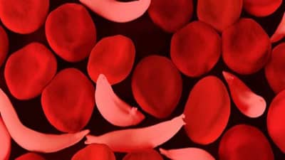 Nagpur Health | सिकलसेल झालाय काय काळजी घ्याल? समाजात 17 डिसेंबरपर्यंत जनजागृती