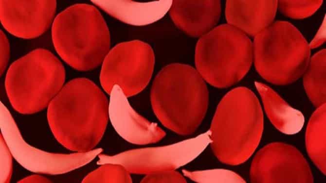 Nagpur Health | सिकलसेल झालाय काय काळजी घ्याल? समाजात 17 डिसेंबरपर्यंत जनजागृती