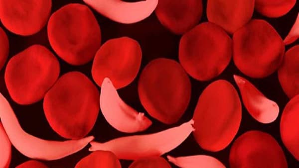 Nagpur Health | सिकलसेल झालाय काय काळजी घ्याल? समाजात 17 डिसेंबरपर्यंत जनजागृती