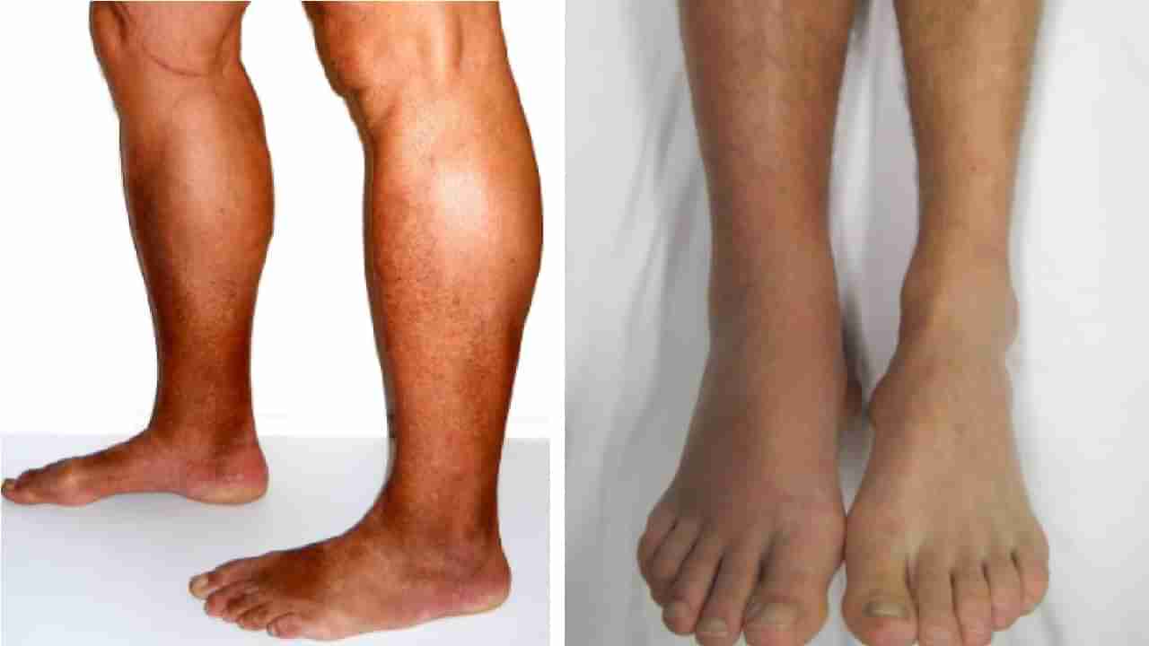 Foot Pain | तुमचेही पाय दुखतात? जाणून घ्या कारणं आणि घरगुती उपाय