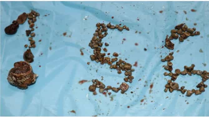 Kidney Stones | पोटदुखीचा त्रास, शिक्षकाच्या पोटात निघाले एक-दोन नव्हे, तब्बल 156 किडनी स्टोन्स