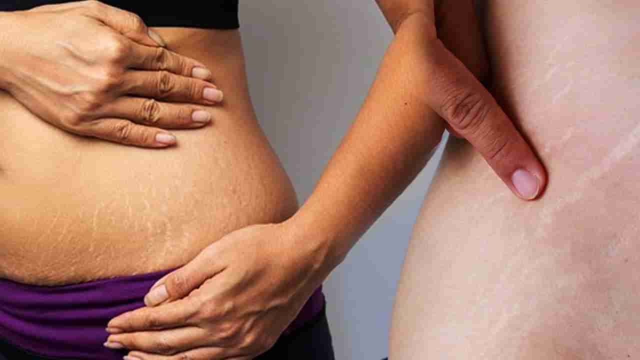 Stretch Marks | स्ट्रेच मार्क्समुळे वैतागलात? हवे तसे कपडे घालता येत नाही? करा हे घरगुती उपाय