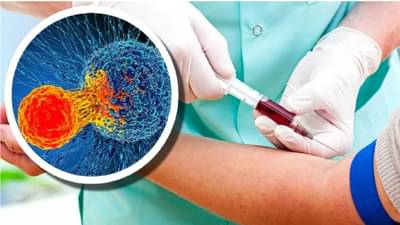 Blood Test | रक्त चाचणीतूनही होणार कॅन्सरचे निदान, शरीरात कर्करोग किती पसरलाय, हेही समजणार
