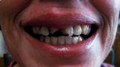 इतर तरुणांची नजर आपल्या प्रेयसीवर पडू नये म्हणून त्याने चक्क तिचे दोन दात तोडले