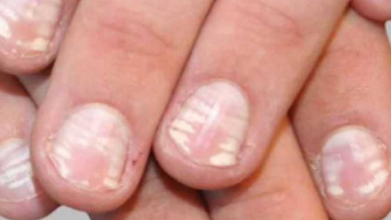 Did you know before? Here's what the white dots on your nails mean - JETË