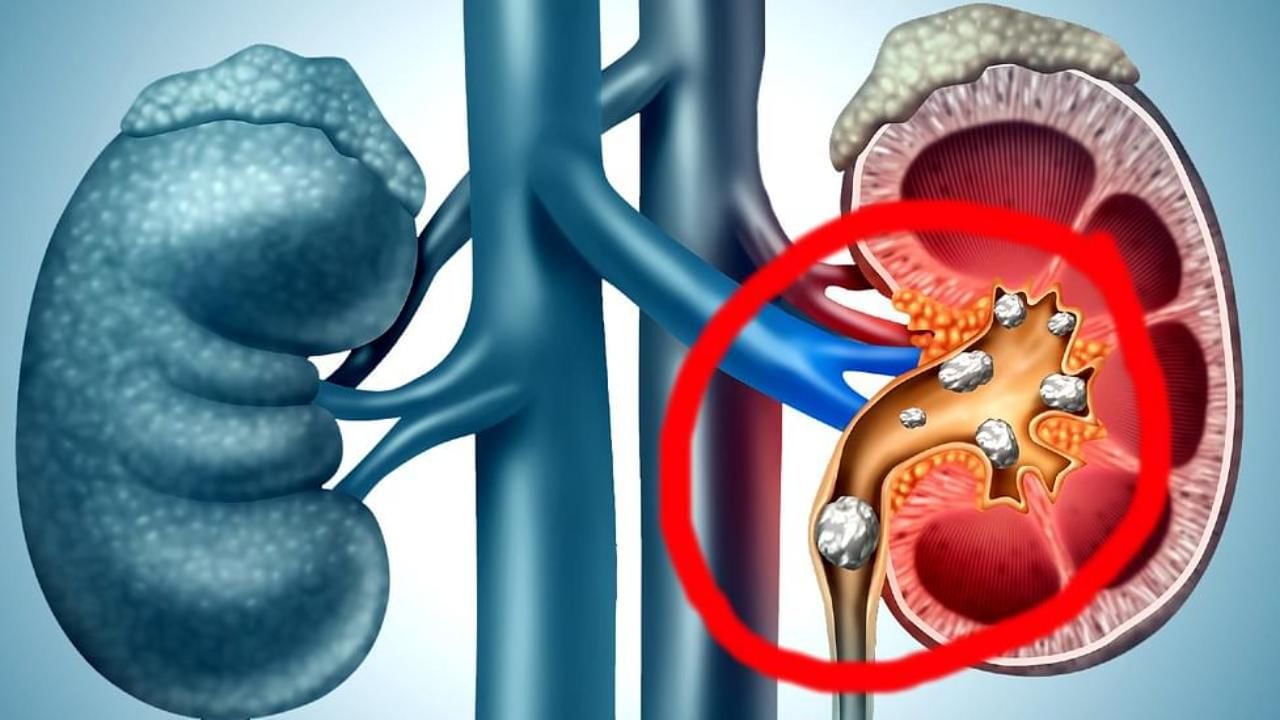 Kidney Stones: कोणतेही ऑपरेशन न करता सहज गळून जाईल किडनी स्टोन! या रसांचे करा नेहमी सेवन