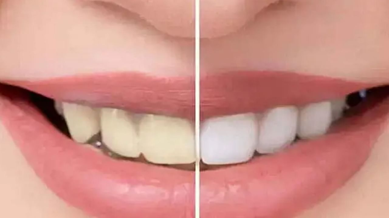 पिवळ्या दातांमुळे त्रस्त आहात? या घरगुती उपायांनी दातांवरील चमक वाढवा