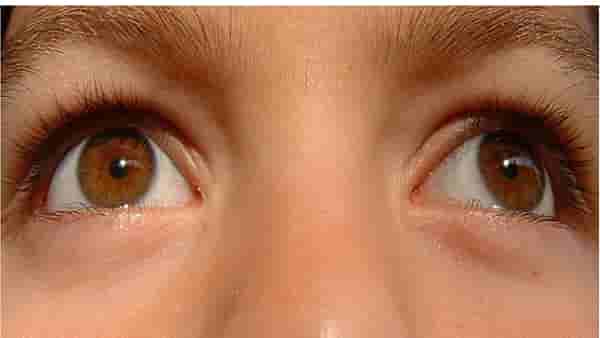 Symptoms of High Cholesterol : कोलेस्ट्रॉल वाढल्याच्या खुणा डोळ्यांवरही दिसतात? जाणून घ्या लक्षणं