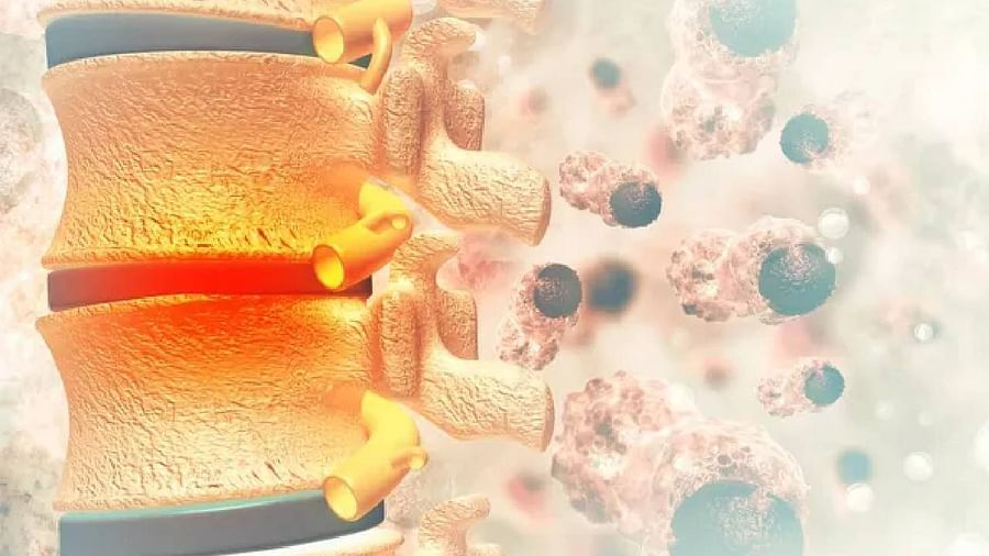 Bone Cancer : हाडांच्या कर्करोगापूर्वी मिळतात पाच संकेत, चुकूनही दुर्लक्ष करु नका... Bone Cancer : हाडांच्या कर्करोगापूर्वी मिळतात पाच संकेत, चुकूनही दुर्लक्ष करु नका...