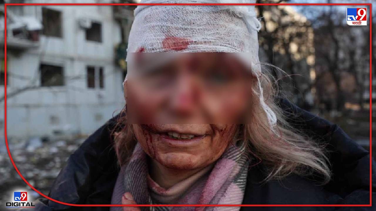 अनेकजण रशियाच्या हल्ल्यात गंभीररीत्या जखमी झाले आहेत. (Photo Source - PTI)