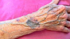 Blue veins : तुमच्या हातापायावरही निळ्या नसा दिसतात का? 'ही' आहेत त्याची कारणं...