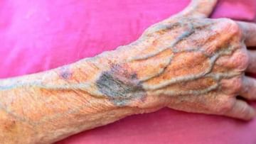 Blue veins : तुमच्या हातापायावरही निळ्या नसा दिसतात का? 'ही' आहेत त्याची कारणं...