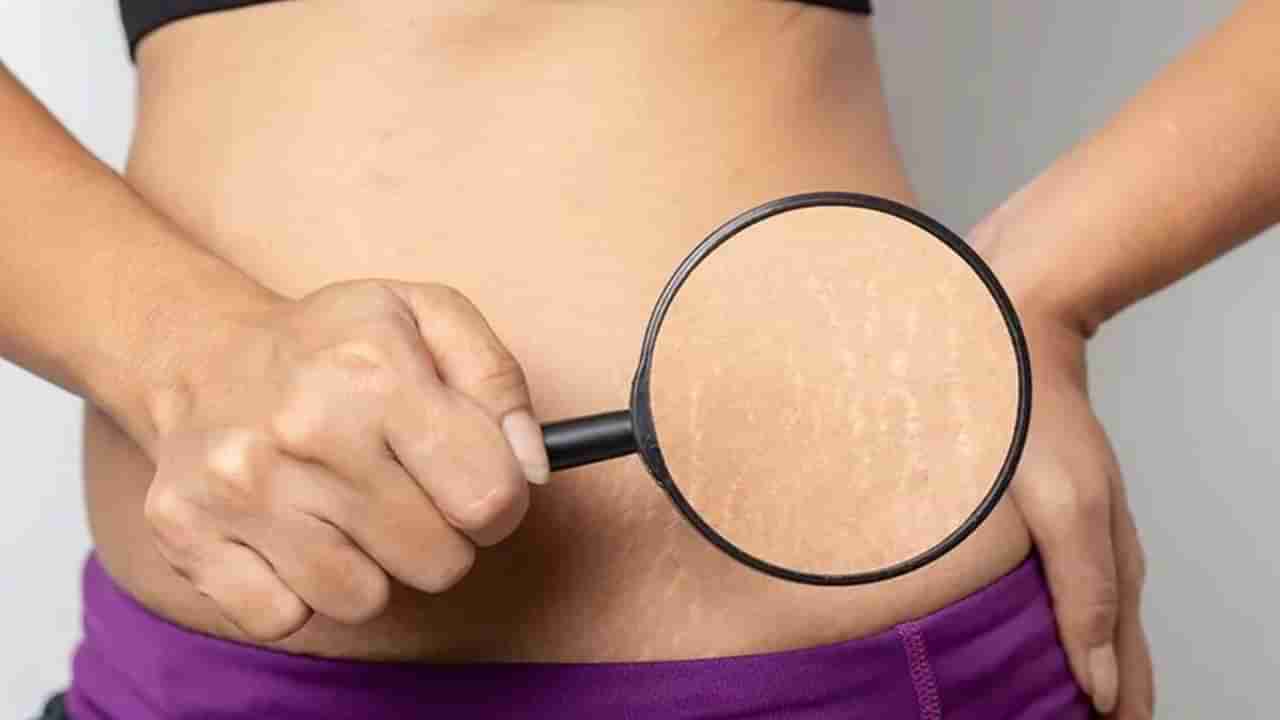 Stretch Marks : ‘स्ट्रेच मार्क्स’बद्दलचे समज-गैरसमज; काय खरं, काय खोटं?