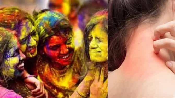 Skin Care : होळी खेळल्यानंतर त्वचेवर अॅलर्जी होते? मग हे 5 उपाय नक्कीच कामी येतील!