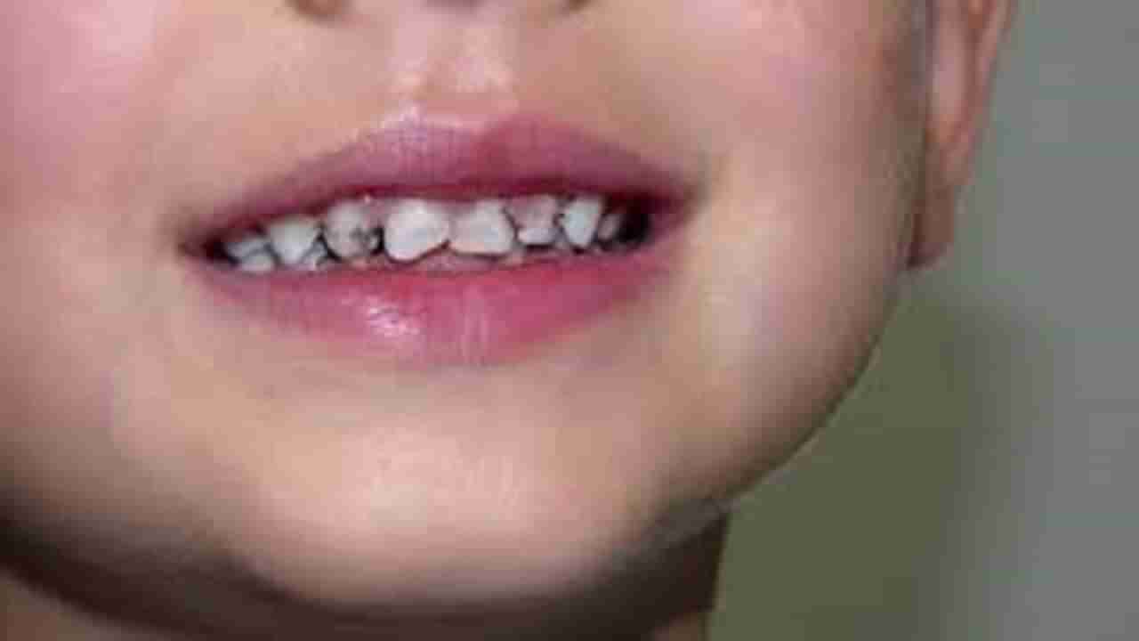 लहान वयातच मुलांच्या दातांना कीड का लागते बरं? जाणून घ्या कारण आणि उपाय