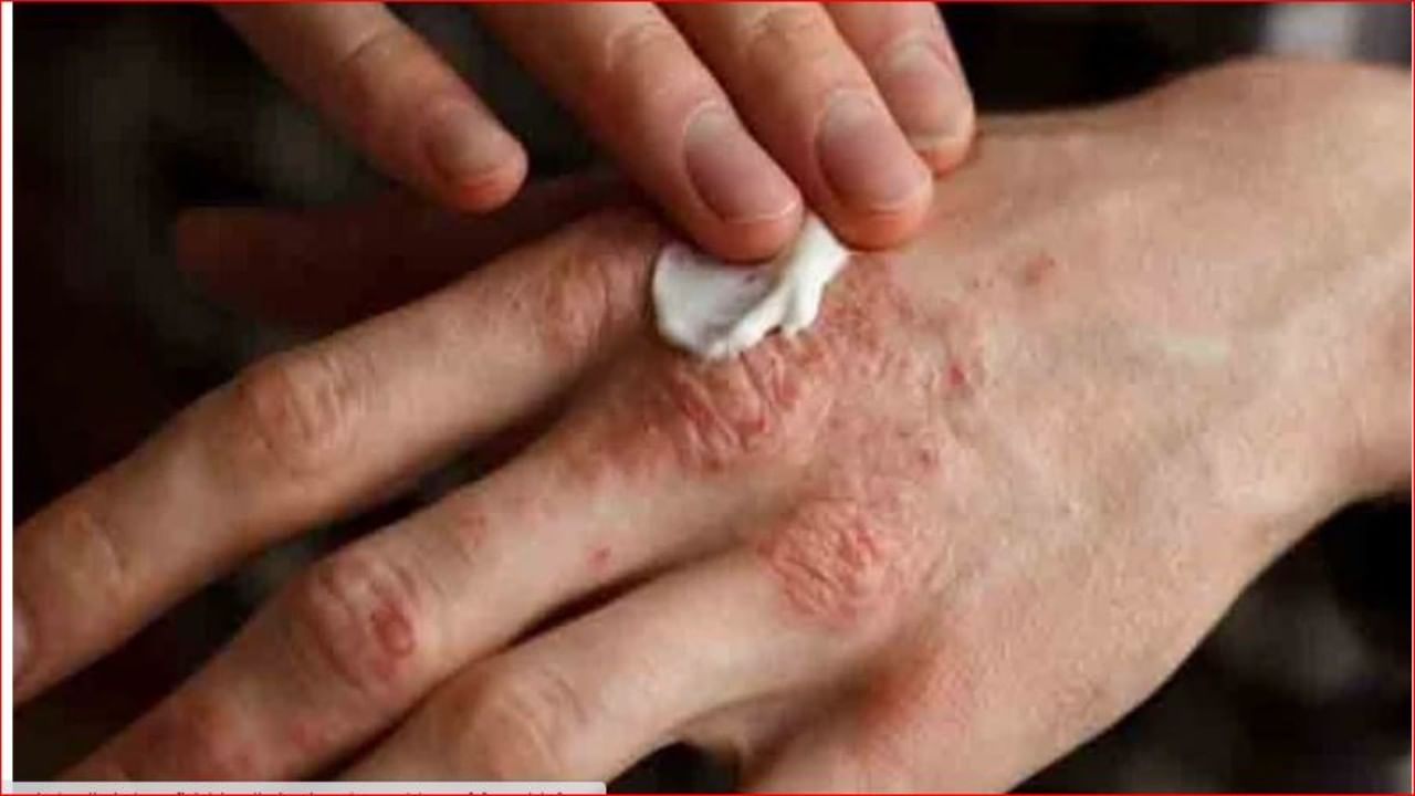 त्वचेला ‘फंगल’पासून वाचवण्यासाठी ‘या’ पाच चुका टाळाच त्वचेला ‘फंगल’पासून वाचवण्यासाठी ‘या’ पाच चुका टाळाच