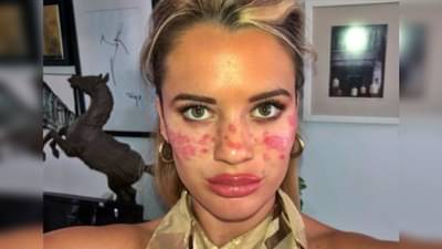 महागात पडलं होम टॅटू हॅक, चेहऱ्यावर डागही पडले अन् तात्पुरतं अंधत्वही आलं; वाचा, बिग ब्रदर स्टार काय म्हणतेय?