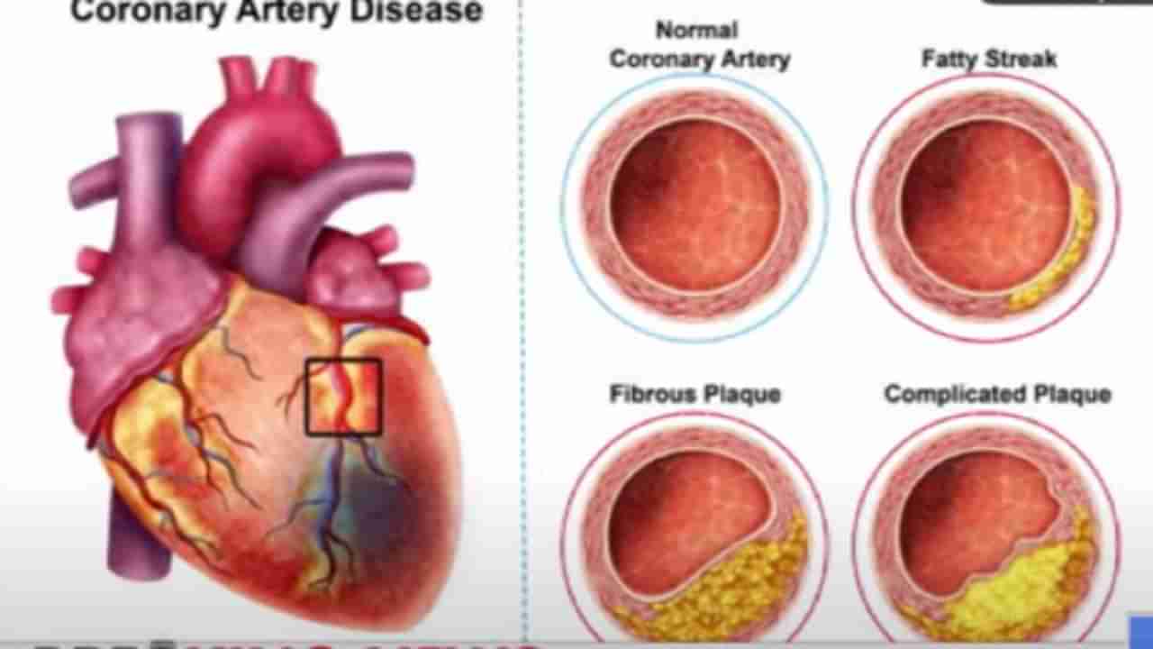 ह्रदयरोग म्हणजे काय, कारणे आणि उपचारपद्धती जाणून घ्या प्रसिध्द डाॅक्टरांकडून!