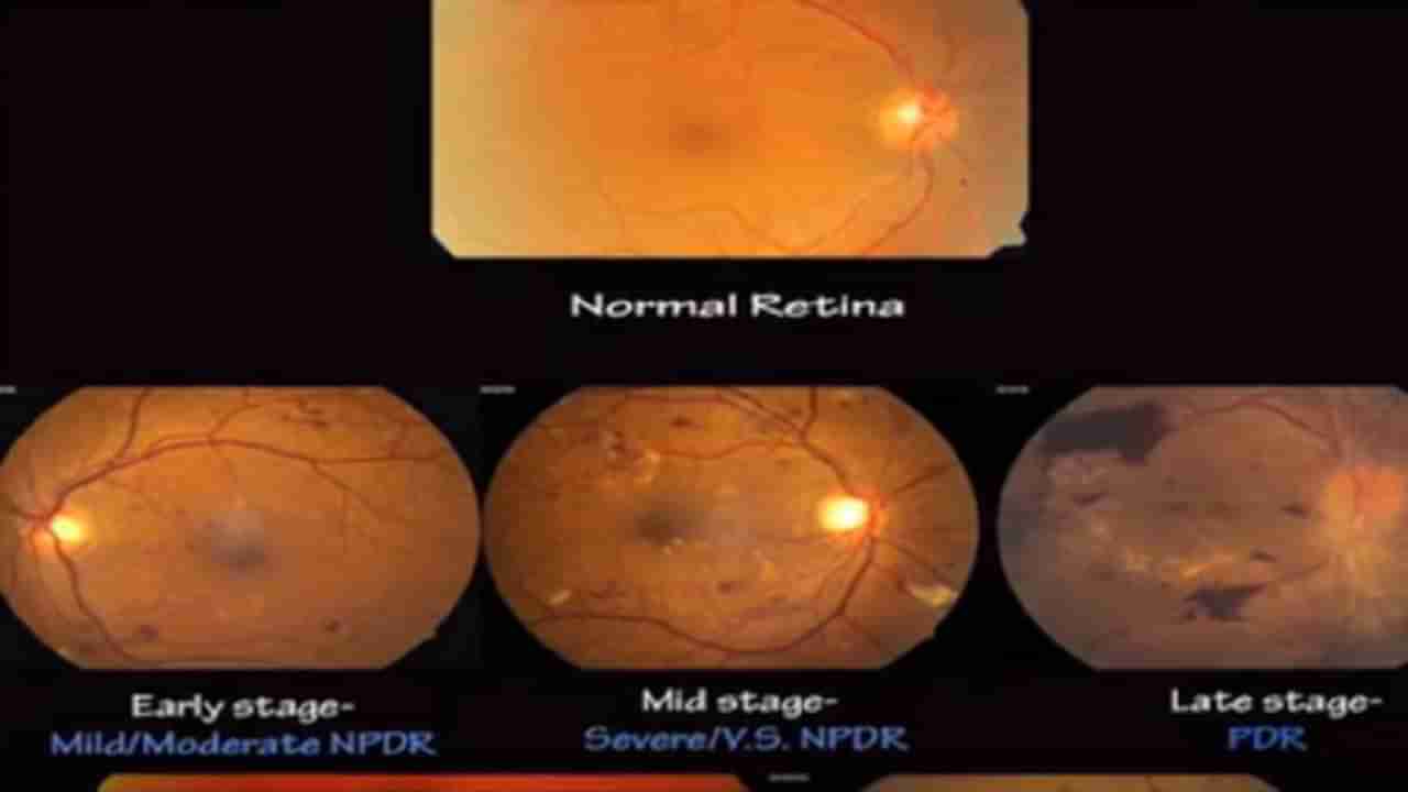 सावधान...! मधुमेहामुळे डोळ्यांचे होऊ शकतात गंभीर विकार या लक्षणांकडे अजिबात दुर्लक्ष करू नका, जाणून घ्या डाॅक्टरांचे मार्गदर्शन