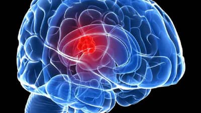 Tumor : अग्नाशयापासून थेट नसांपर्यंत पसरला ट्यूमर... मग झाले असे काही की...