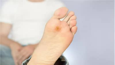 मधुमेह असणाऱ्या रुग्णांसाठी गंभीर; पायाला जखमा होत असतील तर काळजी घ्या