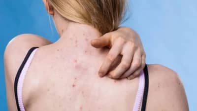 Skin | पाठीवरील पिंपल्स-पुरळाने हैराण आहात? मग पुदीना आणि कोरफडचे जादूई उपयोग नक्की वाचा!