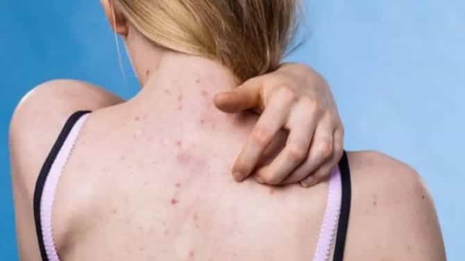 Skin | पाठीवरील पिंपल्स-पुरळाने हैराण आहात? मग पुदीना आणि कोरफडचे जादूई उपयोग नक्की वाचा!