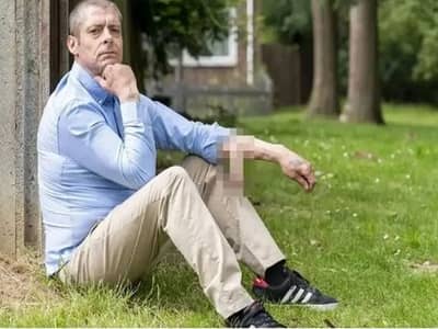 Lifestyle : ऐकावं ते नवलच, इन्फेक्शननं लिंग गळालं, डॉक्टरांनी नवं जोडलं तेही हातावर, पुढं जे घडलं ती सहा वर्षांची वेदना