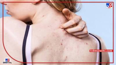Beauty Tips : पाठीवरच्या डागांनी त्रस्त आहात? फक्त या तीन गोष्टी करा आणि फरक अनुभवा...