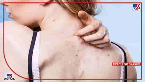 Beauty Tips : पाठीवरच्या डागांनी त्रस्त आहात? फक्त या तीन गोष्टी करा आणि फरक अनुभवा...