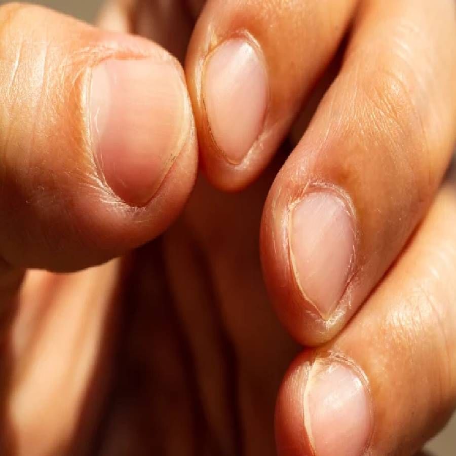 Want to get rid of dark circles under the nails? Then definitely use this  cuticle oil! | Cuticle oil is beneficial for removing dark skin on the skin  | PiPa News