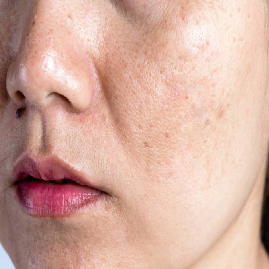 वाढत्या प्रदूषणाचा आपल्या त्वचेवर वाईट परिणाम होतो. त्यामुळे त्वचेशी संबंधित अनेक समस्यांना सामोरे जावे लागते. यामध्ये पिग्मेंटेशनची समस्या प्रामुख्याने निर्माण होते. फ्रिकल्समुळे त्वचेवर डाग दिसू लागतात. ते चेहऱ्याचे सौंदर्य कमी करतात. पिगमेंटेशनपासून मुक्त होण्यासाठी तुम्ही विविध घरगुती उपाय करून पाहू शकता. 