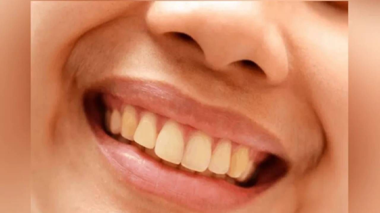 Teeth | या 4 गोष्टींमुळे दातांमध्ये पिवळेपणा येतो, हे पदार्थ खाण्याच्या अगोदर नक्कीच विचार करा!