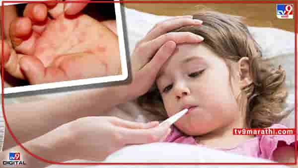 Tomato flu: आता ‘टोमॅटो फ्लू’ची धास्ती; केरळमध्ये 80 हून अधिक मुले आजारी, पाच वर्षांखालील मुलांना जास्त धोका, जाणून घ्या लक्षणे