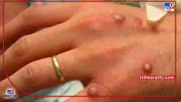OW Monkeypox: कोरोनानंतर आता सामना ‘ओडब्लू मंकीपॉक्स’शी; काय आहेत या आजाराची लक्षणे, कसा होतो संसर्ग?