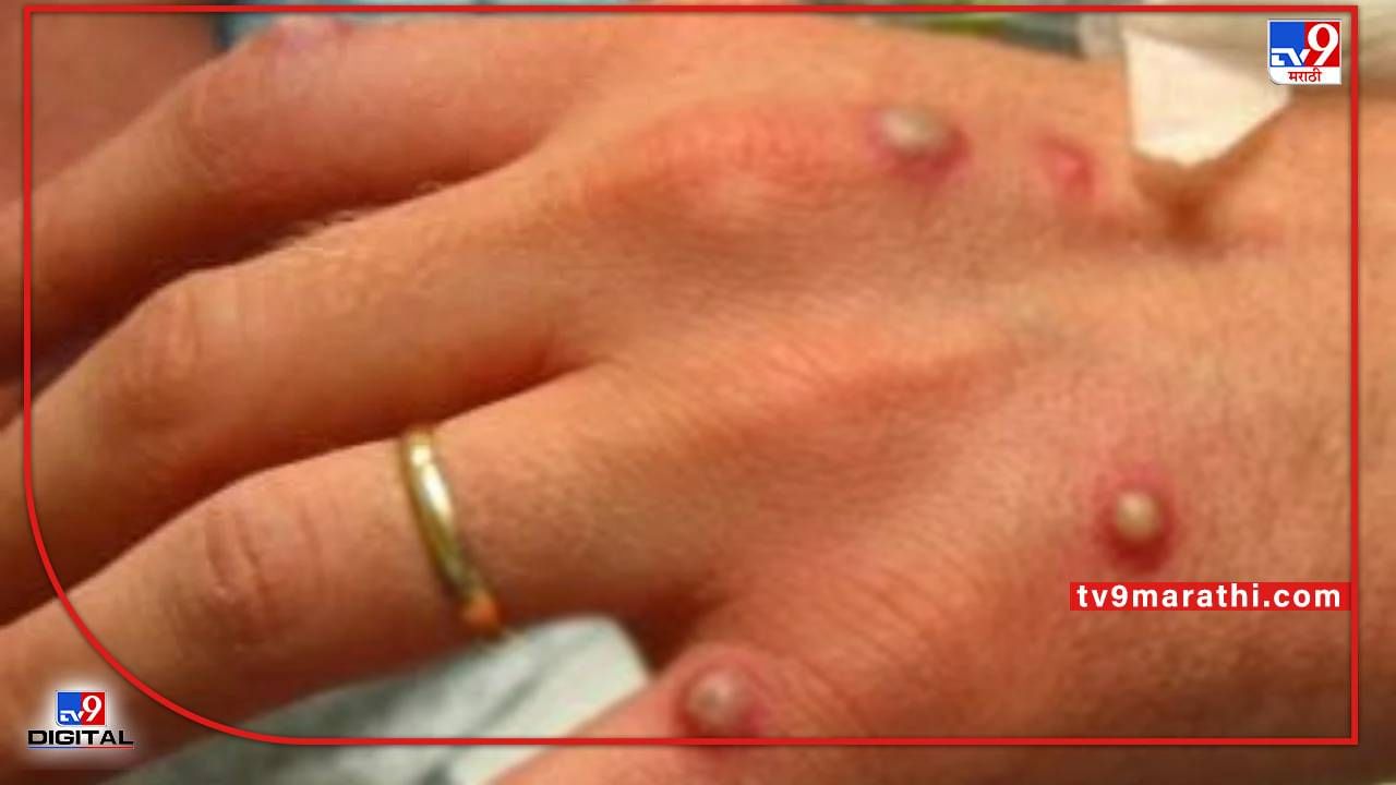 Monkeypox : संक्रमित व्यक्तीच्या सतत समोरासमोर राहिल्यास होऊ शकतो मंकीपॉ़क्स! अमेरिकन CDC चा दावा