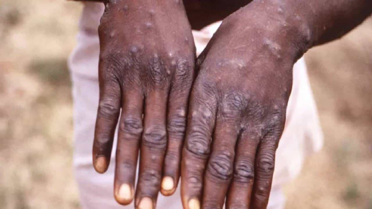 Monkeypox virus | युरोपीय देशांमध्ये मंकीपॉक्स विषाणूचा संसर्ग वाढला, WHO ने घेतली महत्वाची बैठक!
