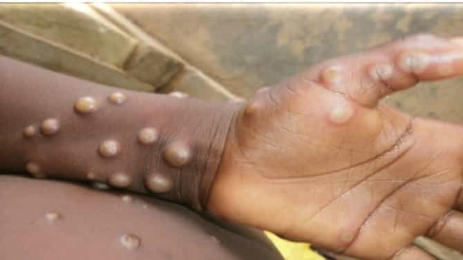 Monkeypox : मंकीपॉक्सच्याविरोधात लढण्यासाठी मुंबई महापालिका सज्ज, विमानतळावरच तपासणी, संशयीत रुग्णांसाठी स्वतंत्र व्यवस्था