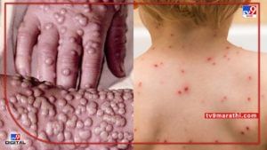 Monkeypox : मंकीपॉ़क्स लहान मुलांसाठी जास्त धोकादायक, ICMRचा इशारा, 20 दिवसांत 21 देशांत 221 जणांना लागण 