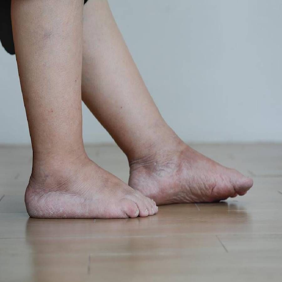 कोथिंबीर बारीक करून पेस्ट बनवा. ही पेस्ट तुमच्या पायावर लावा, धण्यामध्ये अँटीमाइक्रोबियल आणि अँटी-इंफ्लेमेटरी गुणधर्म असतात, जे जळजळ कमी करण्यास मदत करतात. कोरडे झाल्यानंतर कोमट पाण्याने पाय स्वच्छ करा.