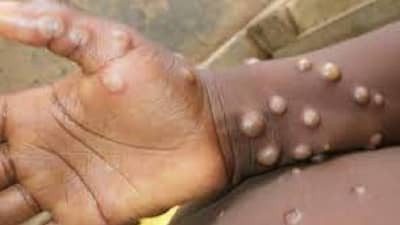 Monkeypox : दिल्लीत मंकीपॉक्सचा पहिला रुग्ण आढळला; मौलाना आझाद मेडिकल कॉलेजमध्ये दाखल